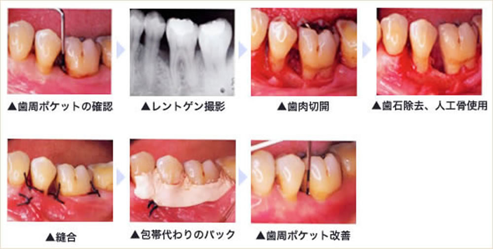 外科処置や歯周再生療法